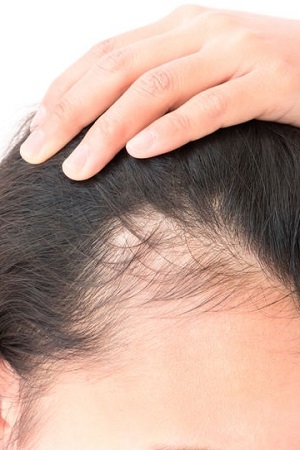 HAIR LOSS WIGS IN LIMERICK AND GALWAY AT BELLISSIMO SALONS HAIR LOSS WIGS IN LIMERICK AND GALWAY AT BELLISSIMO SALONS